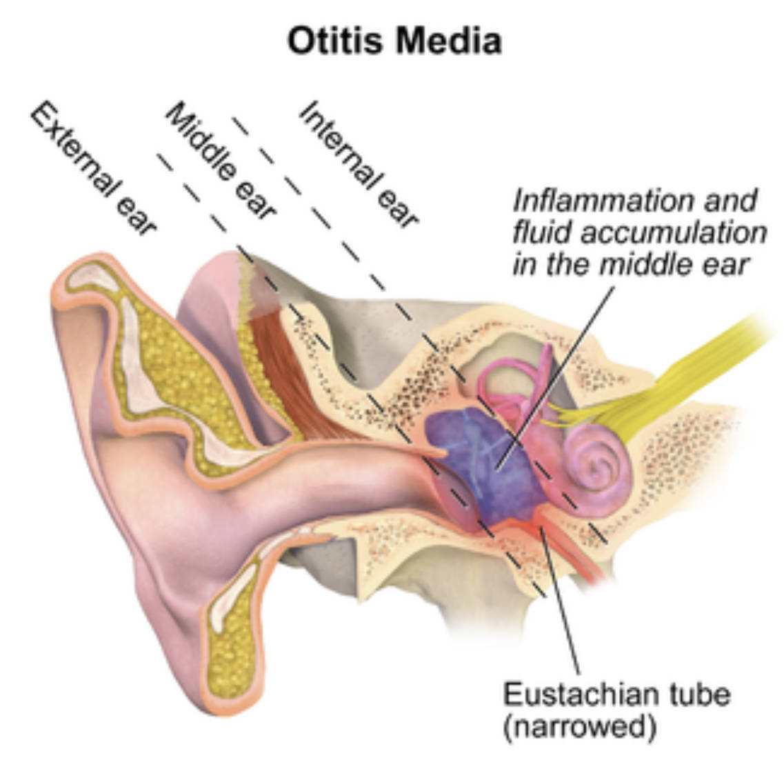 بالىلاردا قۇلاقتىن يىرىڭ ئېقىش كۆرۈلسە قانداق قىلىش كېرەك؟ بالىلاردا قۇلاقتىن يىرىڭ ئېقىش كۆرۈلسە قانداق قىلىش كېرەك؟