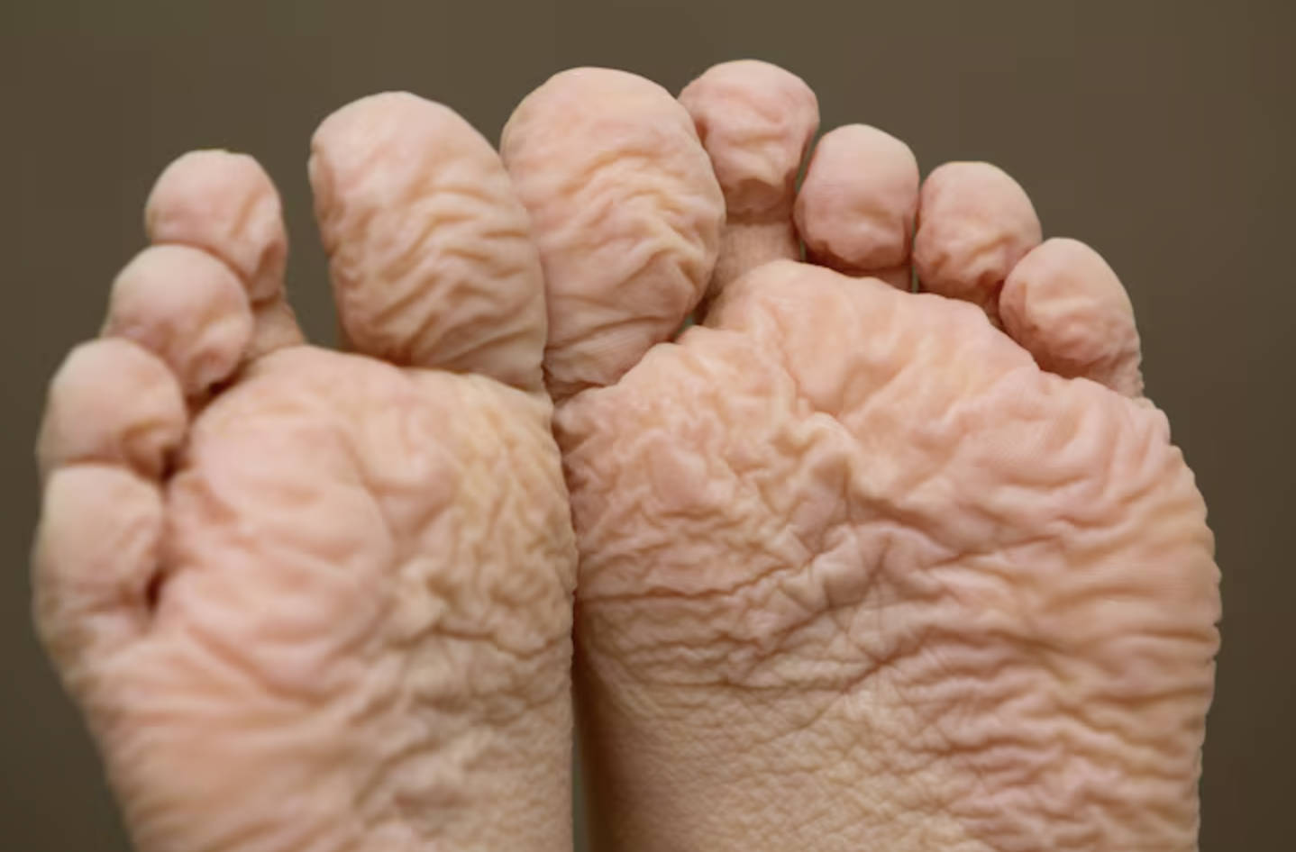 شىكەر كېسىلى بىمارلىرى نېمە ئۈچۈن ھەر كۈنى ئۇخلاشتىن بۇرۇن پۇتنى تەكشۈرۈشى كېرەك؟ شىكەر كېسىلى بىمارلىرى نېمە ئۈچۈن ھەر كۈنى ئۇخلاشتىن بۇرۇن پۇتنى تەكشۈرۈشى كېرەك؟