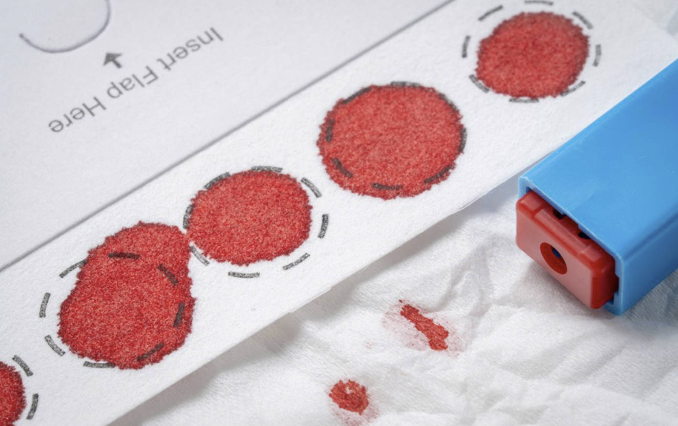 يېڭى قان تەكشۈرۈش ئارقىلىق ئالزېيمېر كېسىلىنى بالدۇر بايقاش ئۇسۇلى ئومۇملىشى مۇمكىن يېڭى قان تەكشۈرۈش ئارقىلىق ئالزېيمېر كېسىلىنى بالدۇر بايقاش ئۇسۇلى ئومۇملىشى مۇمكىن