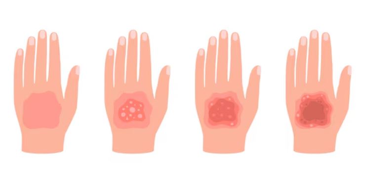 بالىلارنىڭ كۆيۈپ يارىلىنىشىدا قانداق قىلىش كېرەك؟ جىددىي قۇتقۇزۇش ئۇسۇللىرىنى بىلىۋېلىڭ بالىلارنىڭ كۆيۈپ يارىلىنىشىدا قانداق قىلىش كېرەك؟ جىددىي قۇتقۇزۇش ئۇسۇللىرىنى بىلىۋېلىڭ