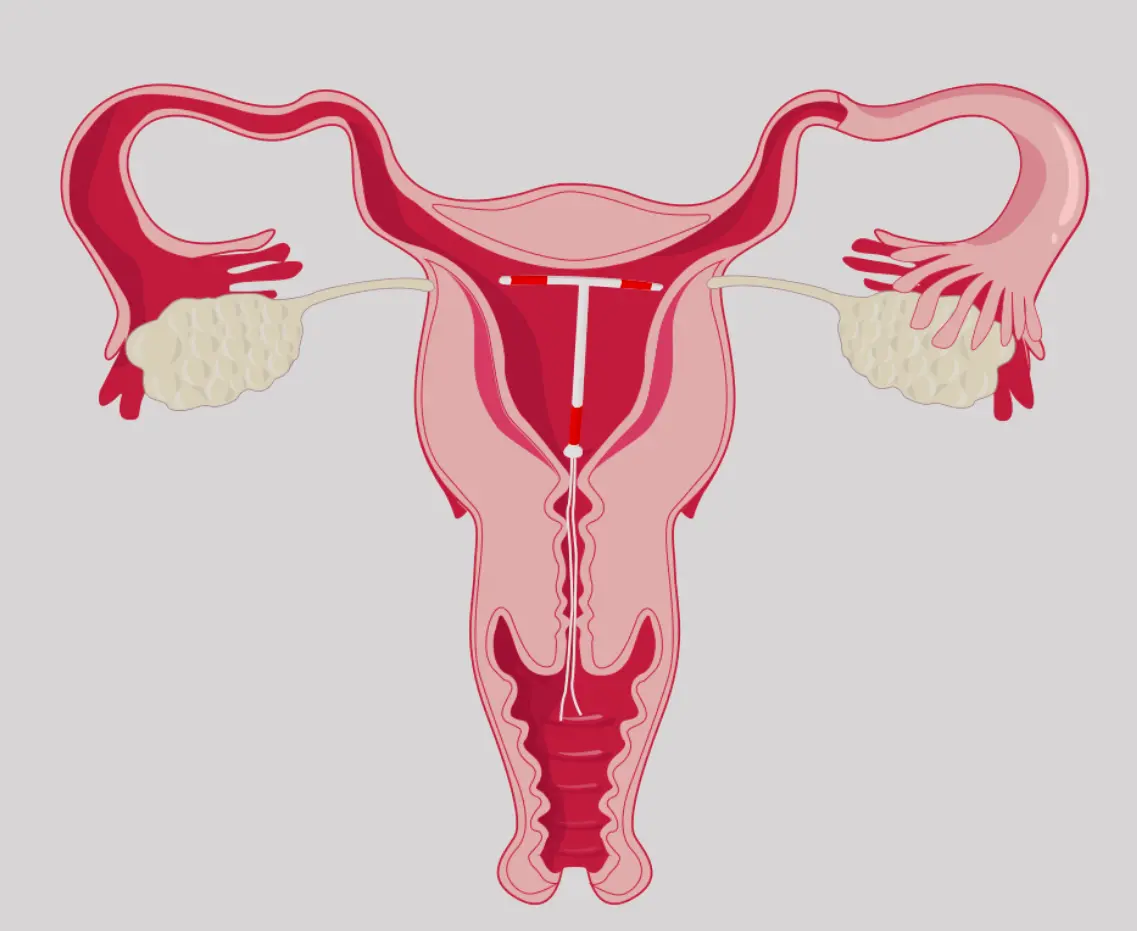 ھامىلىدارلىقتىن ساقلىنىش ھالقىسى بىخەتەرمۇ؟ ھامىلىدارلىقتىن ساقلىنىش ھالقىسى بىخەتەرمۇ؟