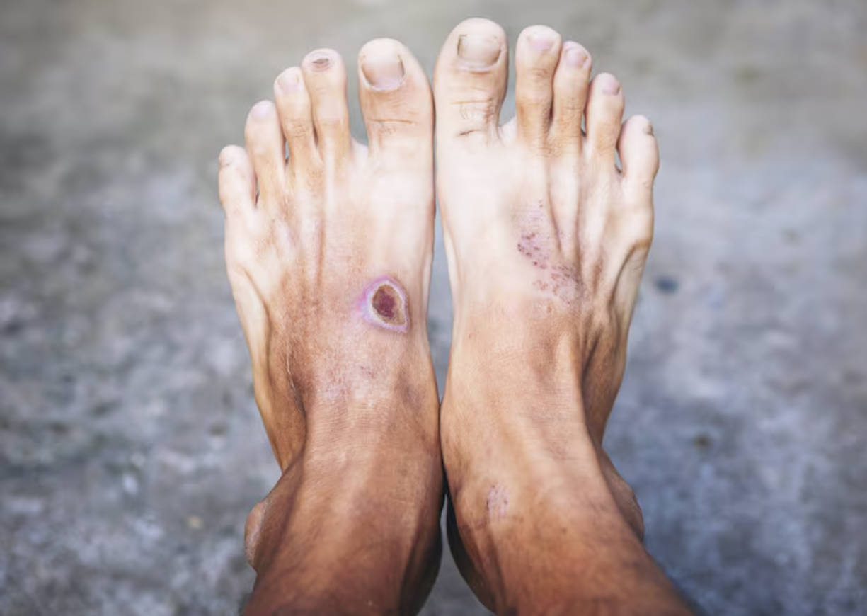 نىمە ئۈچۈن دىئابېت كېسىلى بىمارلىرىنىڭ پۇتى كېسىۋېتىلىدۇ؟ نىمە ئۈچۈن دىئابېت كېسىلى بىمارلىرىنىڭ پۇتى كېسىۋېتىلىدۇ؟