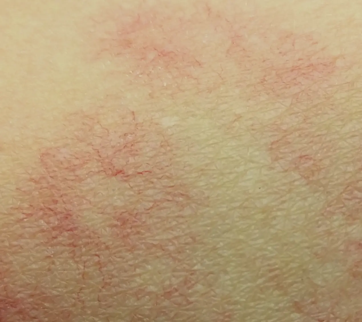 ئۆمۈچۈك مەڭ كۆرۈلسە سەل چاغلىماڭ ئۆمۈچۈك مەڭ كۆرۈلسە سەل چاغلىماڭ