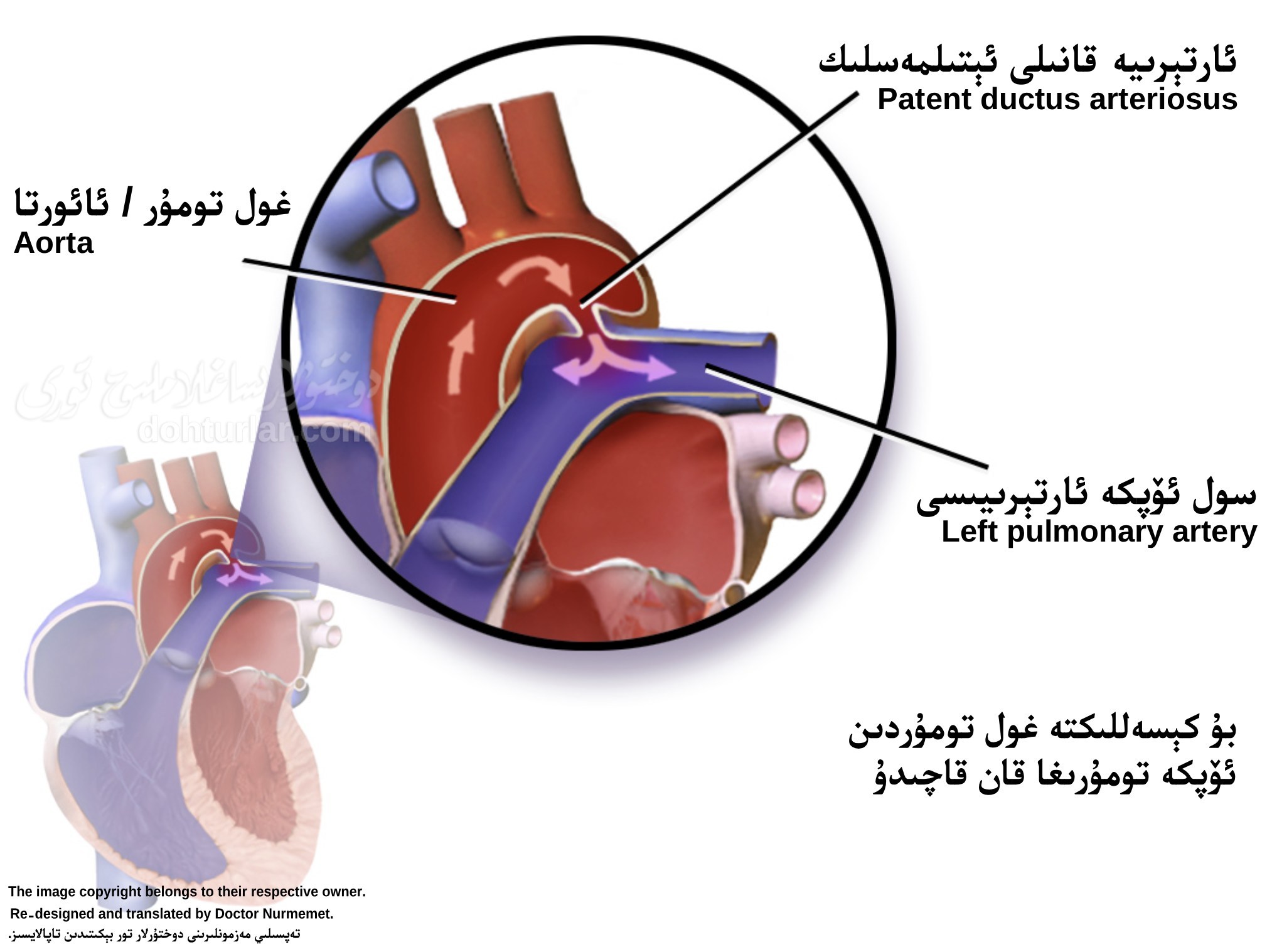 ئارتېرىيە قانىلى ئېتىلمەسلىك (PDA) ئارتېرىيە قانىلى ئېتىلمەسلىك (PDA)