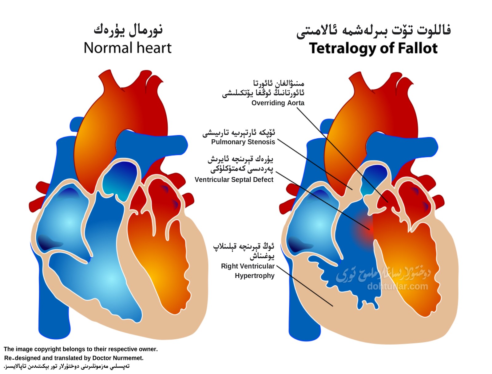 فاللوت تۆت بىرلەشمە ئالامىتى ( Tetralogy of Fallot ) فاللوت تۆت بىرلەشمە ئالامىتى ( Tetralogy of Fallot )