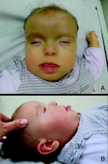 ۋىكىپېدىيادىن ئېلىندى.https://en.wikipedia.org/wiki/Pallister%E2%80%93Killian_syndrome