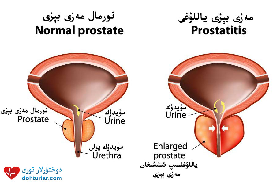 Does prostatitis go away on its own