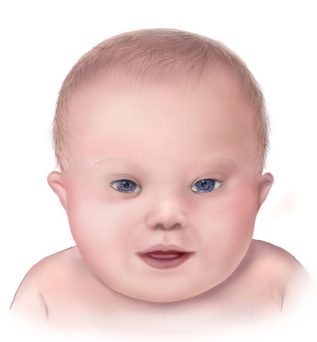 ترىزومى 21 (دوۋن يىغىندى ئالامىتى)