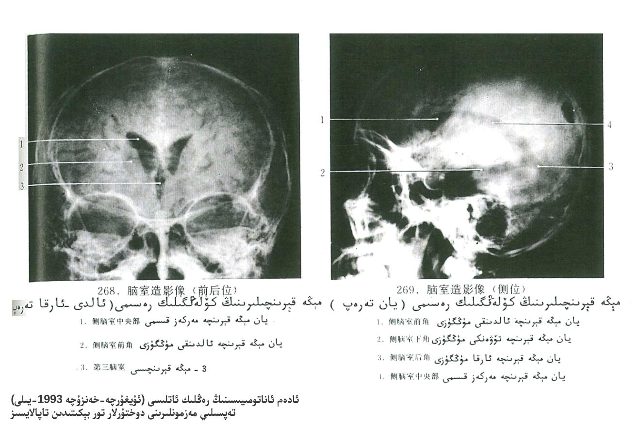 مېڭە قېرىنچىلىرى كۆلەڭگىلىك رەسىمى
