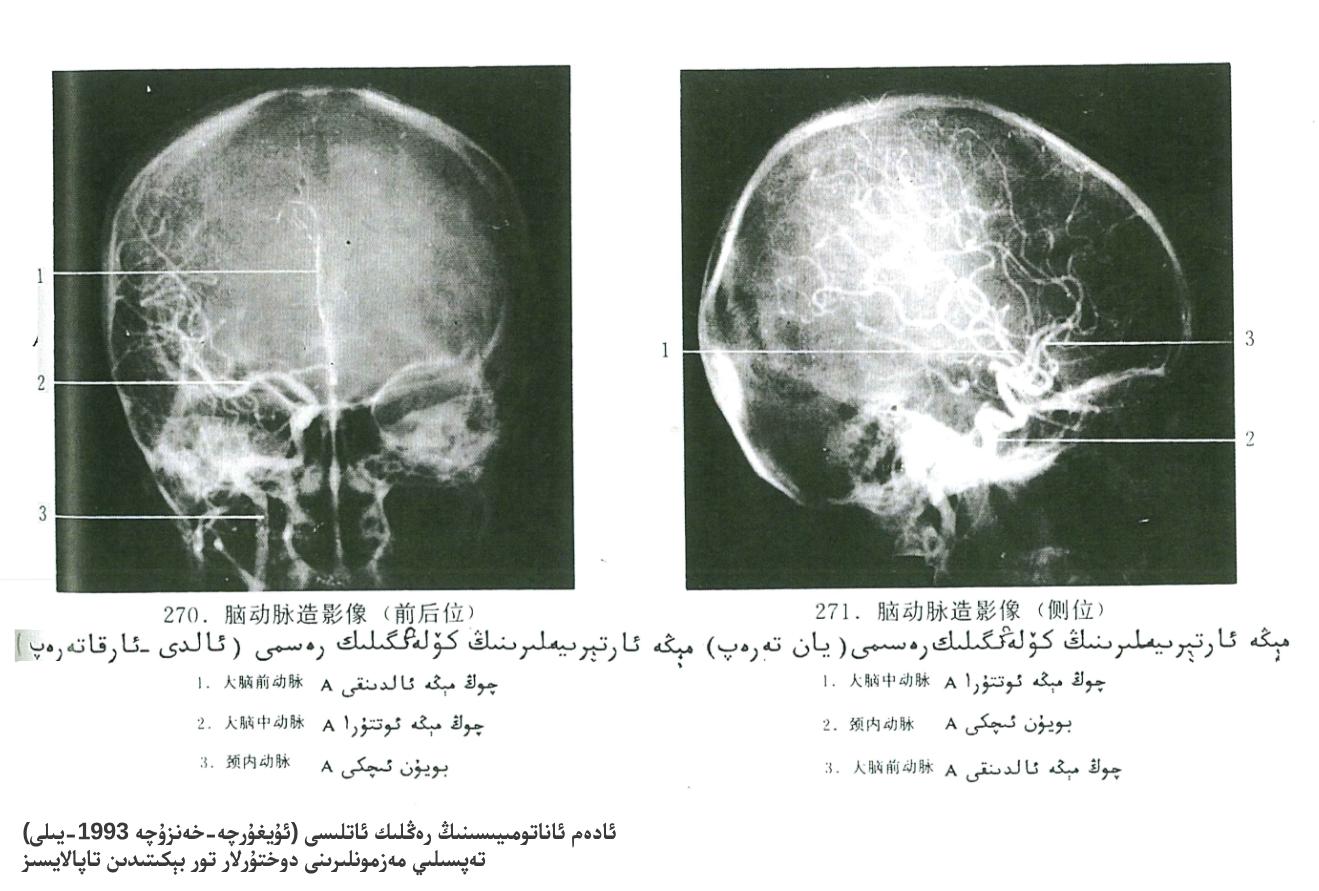 مېڭە ئارتېرىيىلىرى كۆلەڭگىلىك رەسىمى